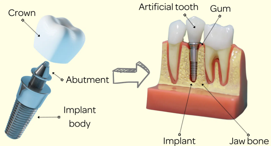 Tracing the Evolution of Dental Implants: A Journey Towards Lifelong Oral Health