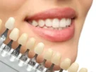 Dental Veneers