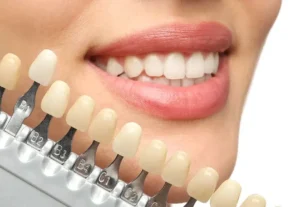 Dental Veneers