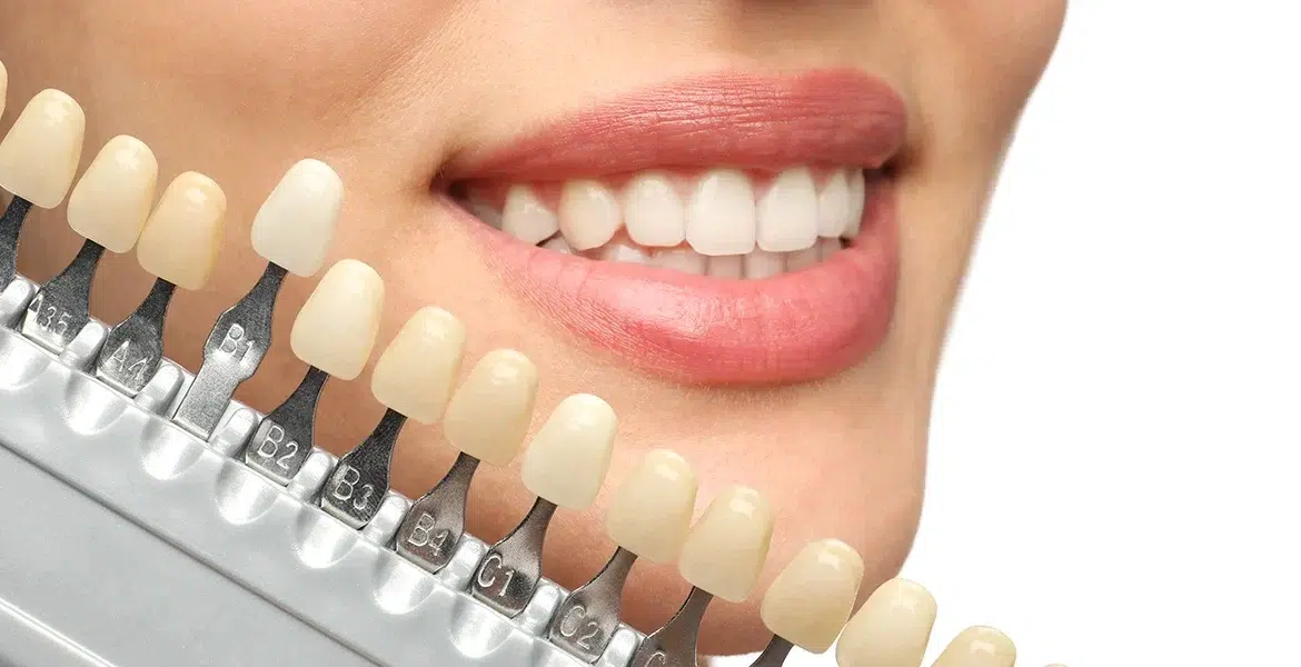 Dental Veneers