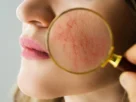 Rosacea