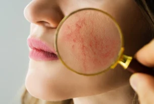 Rosacea