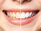 Teeth Whitening