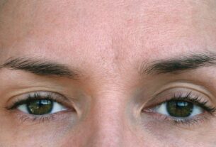 5 Things to Know Before Getting Eyelid Ptosis Surgery