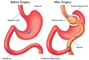 The Pros And Cons Of Mini Gastric Bypass Surgery