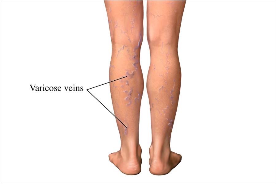 Varicose Vein Treatment