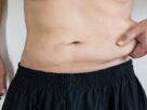 Abdominoplasty