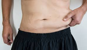 Abdominoplasty