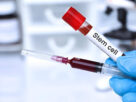 Dubai stem cell therapy