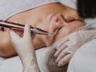 Microneedling