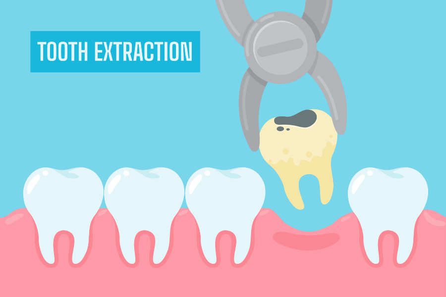 Tooth Extraction