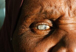 Cataracts