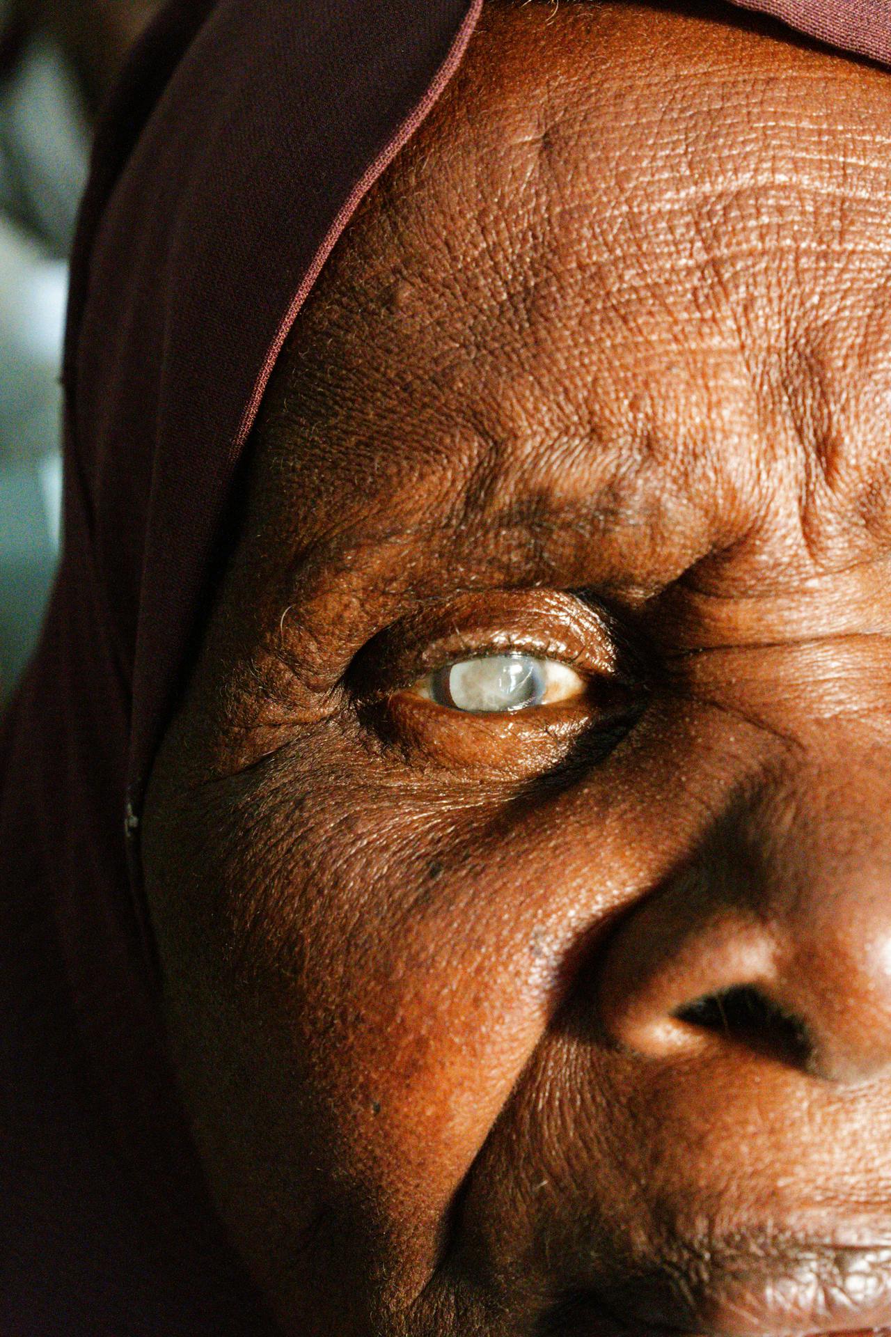 Cataracts