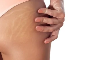 Stretch Marks