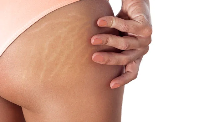 Stretch Marks