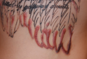 Keloids