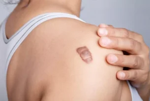 Keloid Scars: Causes, Concerns