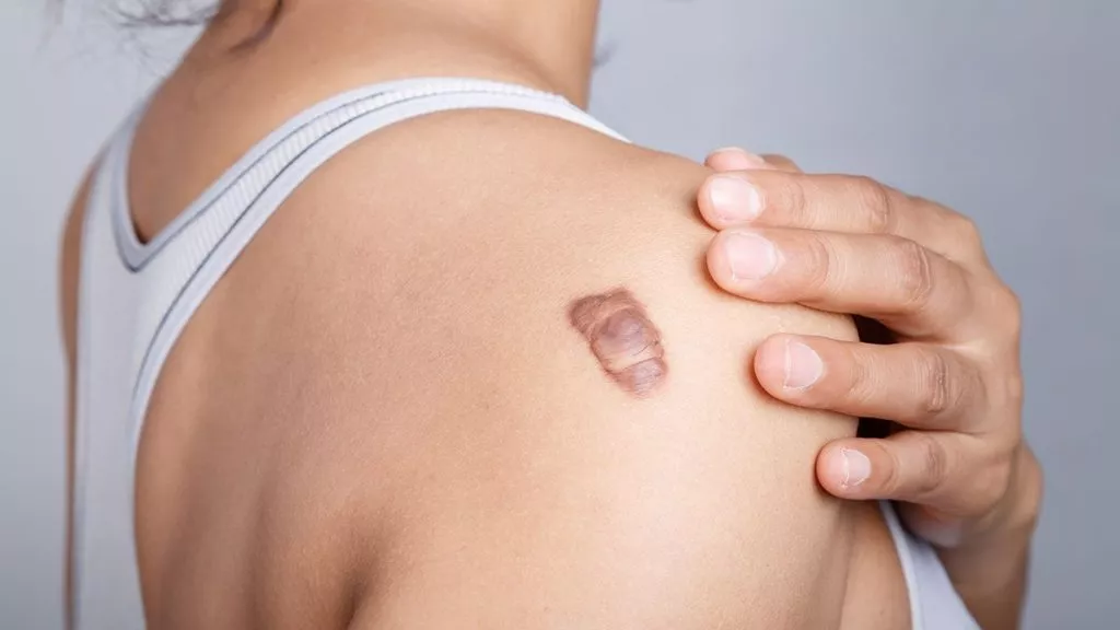 Keloid Scars: Causes, Concerns