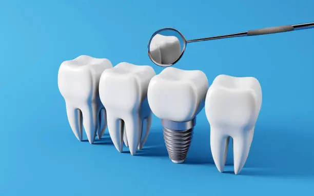 Dental Implants