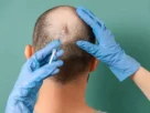 Hair Transplant