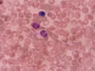 Stem Cell Thalassemia